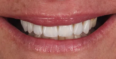 After image of veneers