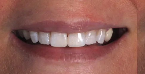 After image of dental bonding