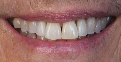 After image of in-office teeth whitening