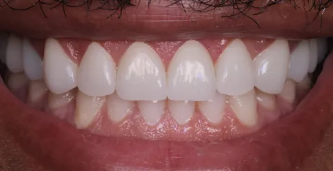 After image of smile makeover