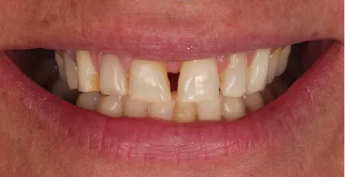 Before image of veneers