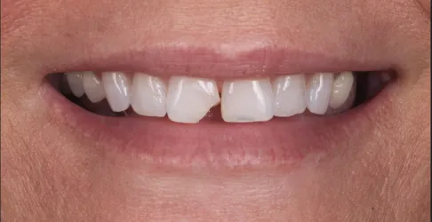 Before image of dental bonding