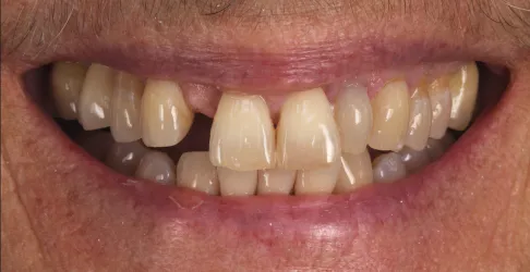 Before image of in-office teeth whitening