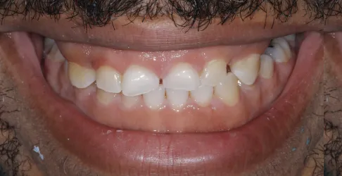 Before image of smile makeover