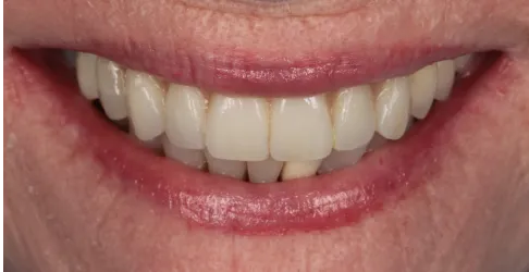 After image of dental bonding