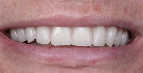After image of in-office teeth whitening