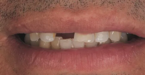 Before image of veneers