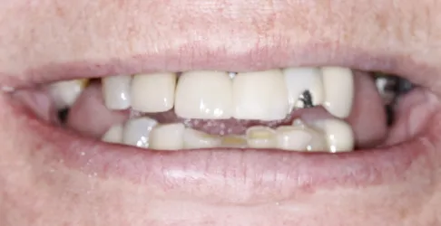 Before image of in-office teeth whitening